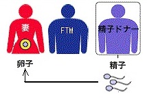 FTM精子ドナー