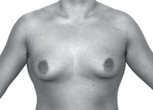 胸オペ（乳房摘出）前